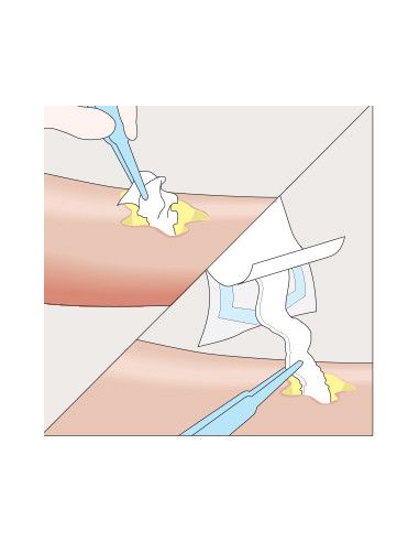 Mesalt medicazione in cloruro di sodio 5x5 1pz