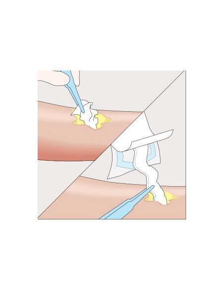 Mesalt medicazione in cloruro di sodio 5x5 1pz