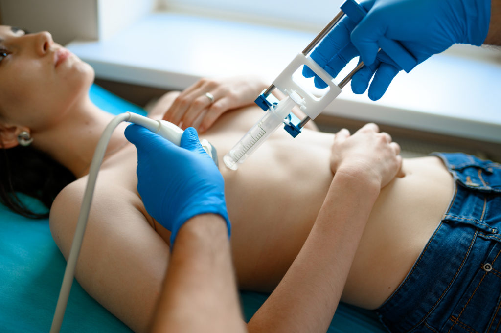 che cos'è la mastectomia