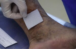 Aquacel, la medicazione avanzata per le lesioni di difficile guarigione