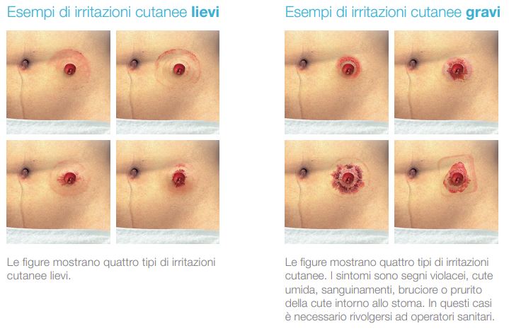 Stomia, guida alla pelle sana Stomia, guida alla pelle sana
